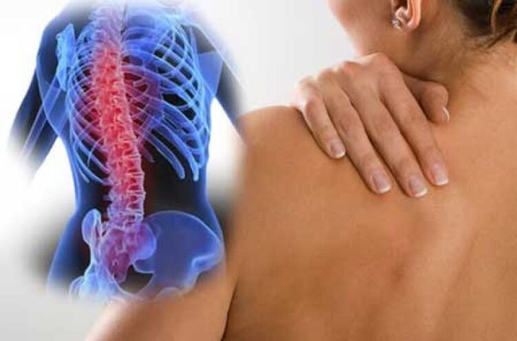 N'oge oke osteochondrosis nke spine thoracic, mgbu dorsago na-apụta. 