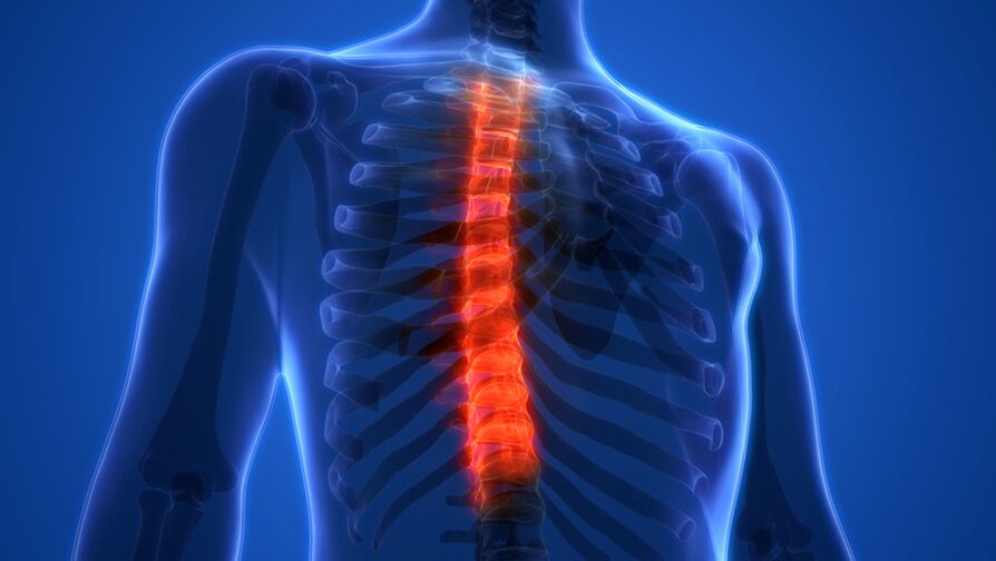 Osteochondrosis nke spine thoracic, nke e ji mbibi nke diski intervertebral mara