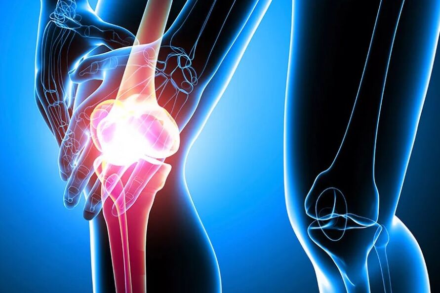 Arthrosis nke ikpere