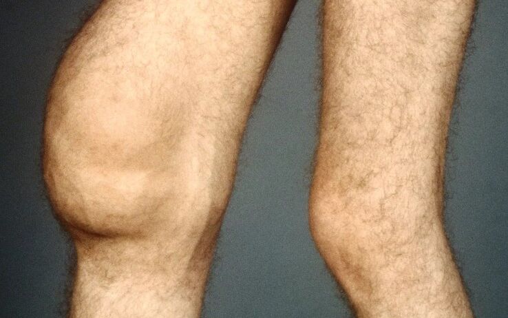 Post -trramatic arthrosis nke nkwonkwo ikpere