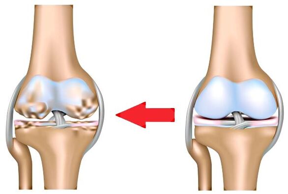 Nkwonkwo na arthrosis