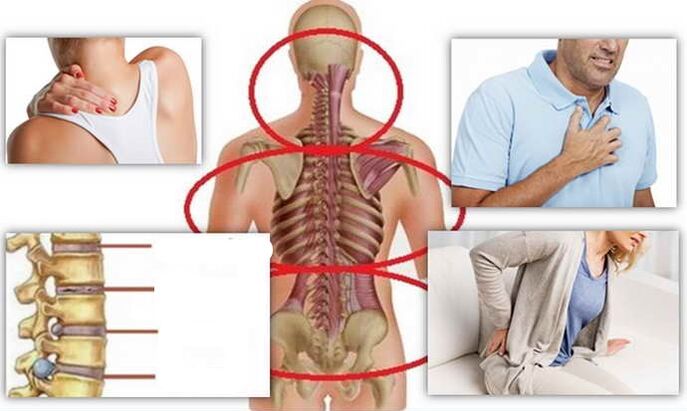 Ebe ọrịa maka osteochondrosis