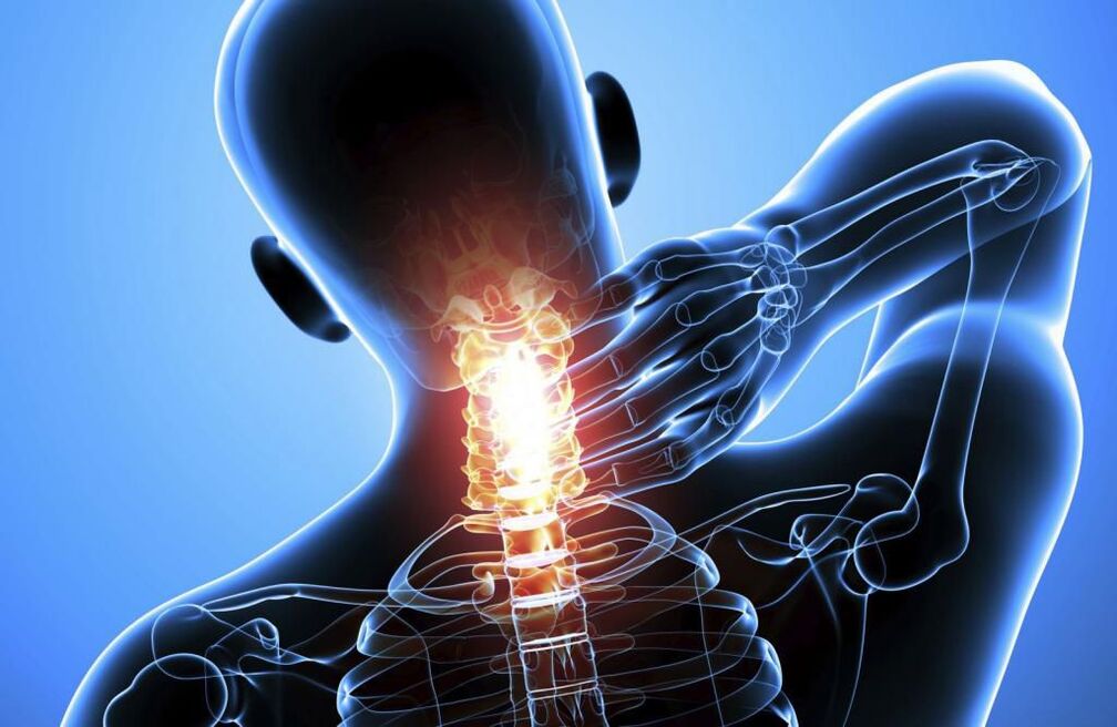 Osteochondrosis nke cervical spine