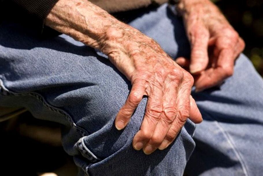 Arthrosis bụ ọrịa na-emetụta afọ nke na-eme na ndị agadi