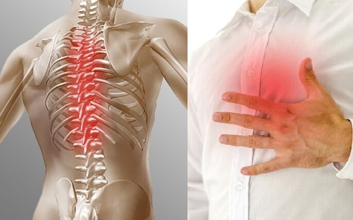 A na-egosipụta osteochondrosis nke thoracic site na mgbu na mmetụta nke ike n'ime obi
