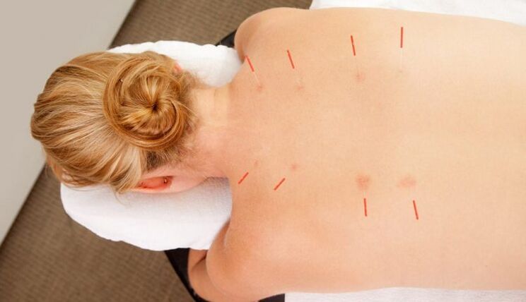 Acupuncture maka thoracic osteochondrosis, nke nwere ọtụtụ uru